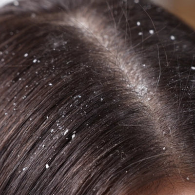 Dandruff
