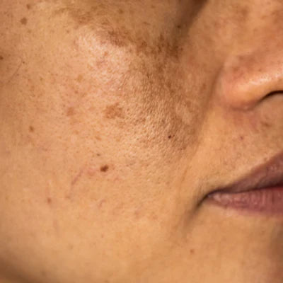 Melasma